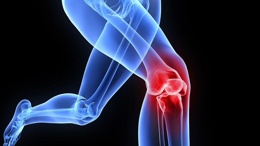 težave s koleni zaradi artroze