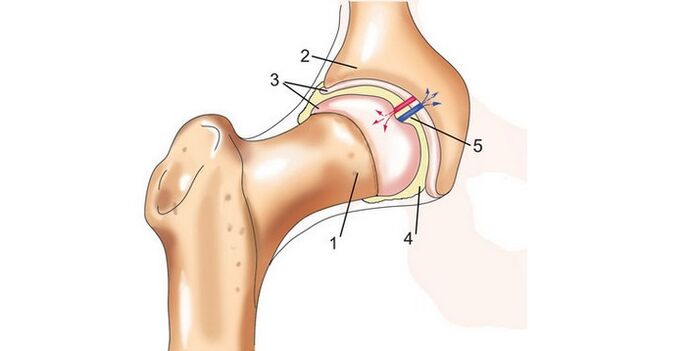 kolčnega sklepa in artroze