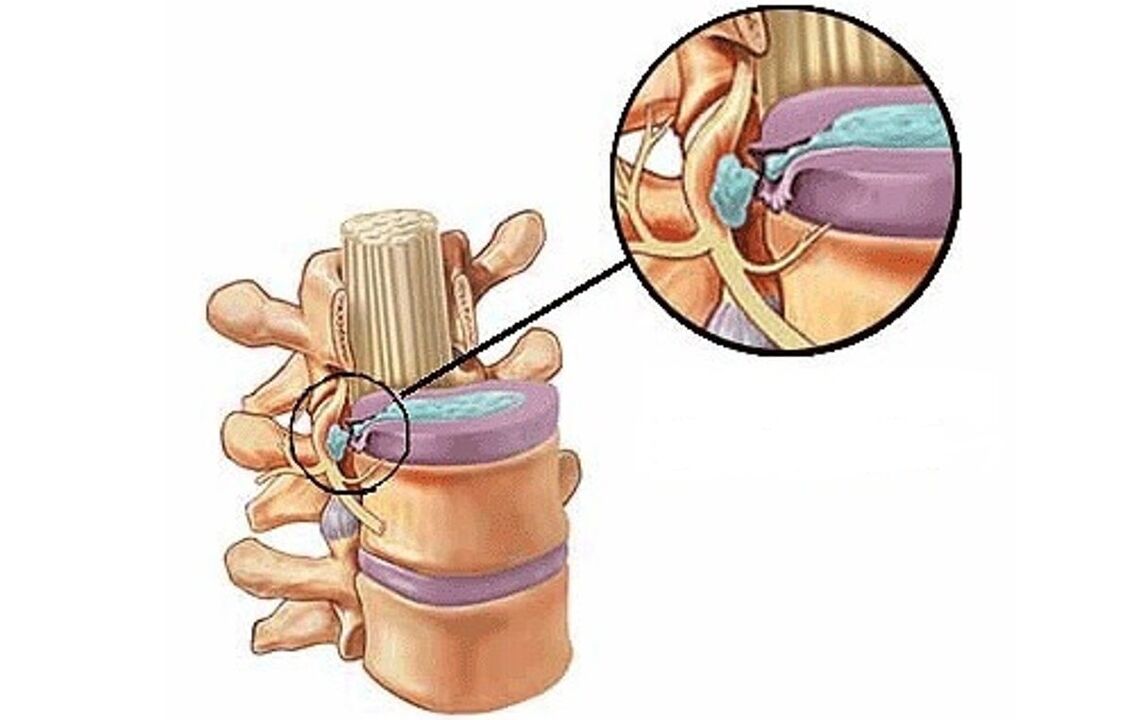 medvretenčna kila s torakalno osteohondrozo